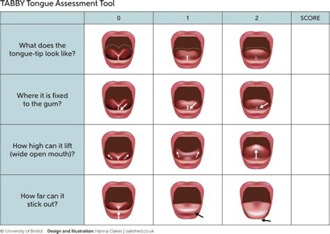 Tongue tie melton  It is a congenital anomaly in which the lingual frenulum restricts the mobility of the tongue []